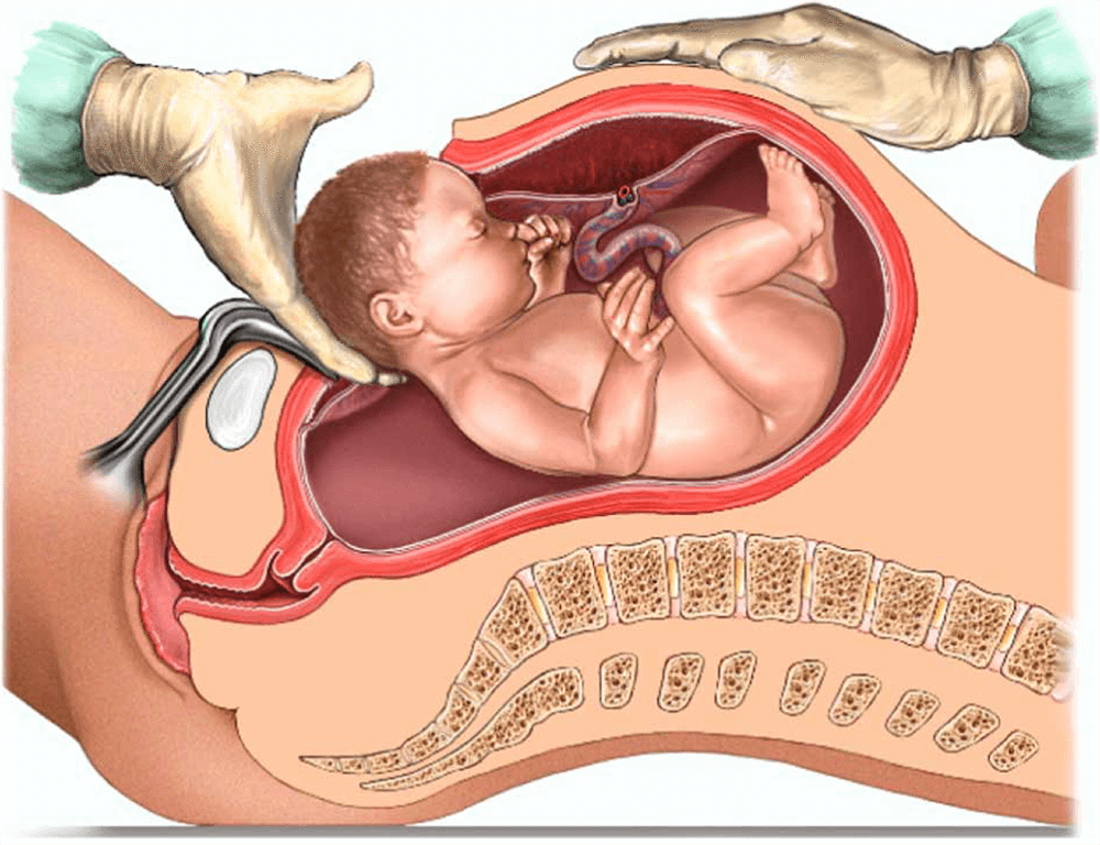 caesarean-section frontpage news