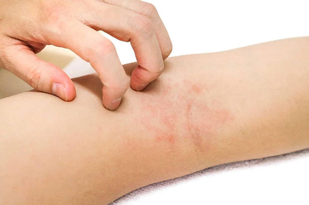 eczema-and-skin-rashes